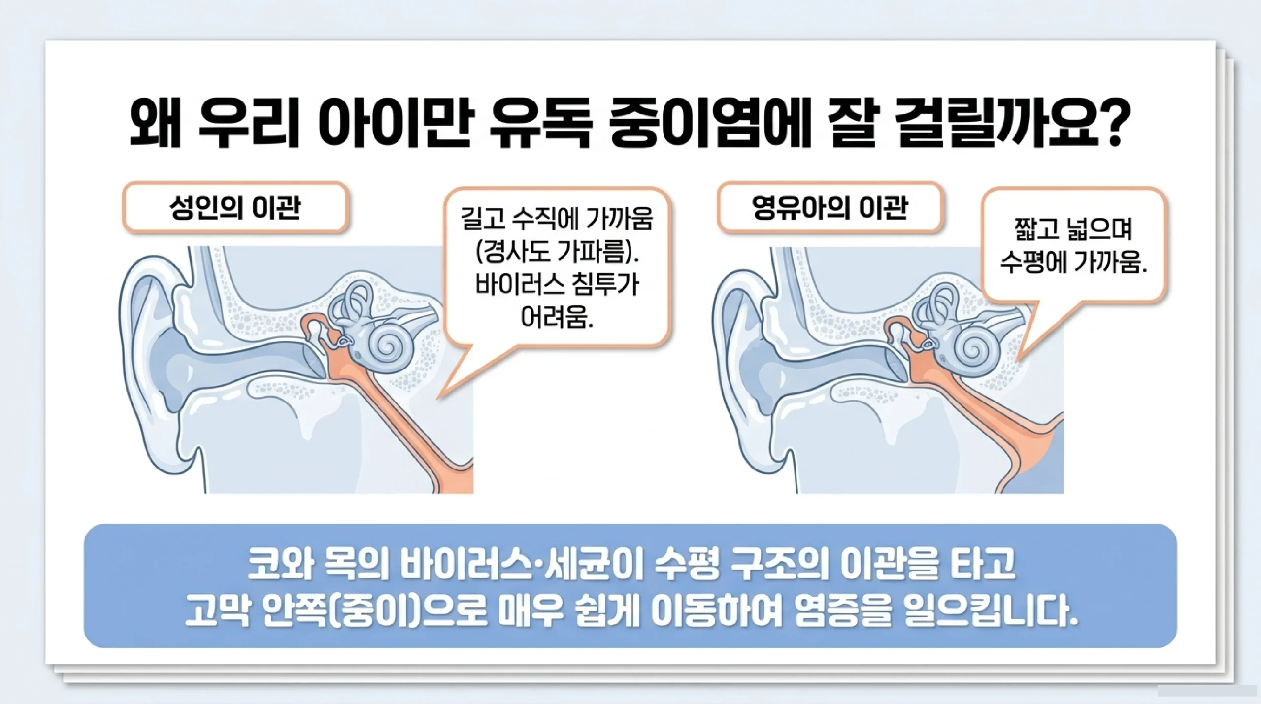 중이염 급성 vs 삼출성 한눈 비교 — 원인·증상·항생제 여부·자연치유 가능성