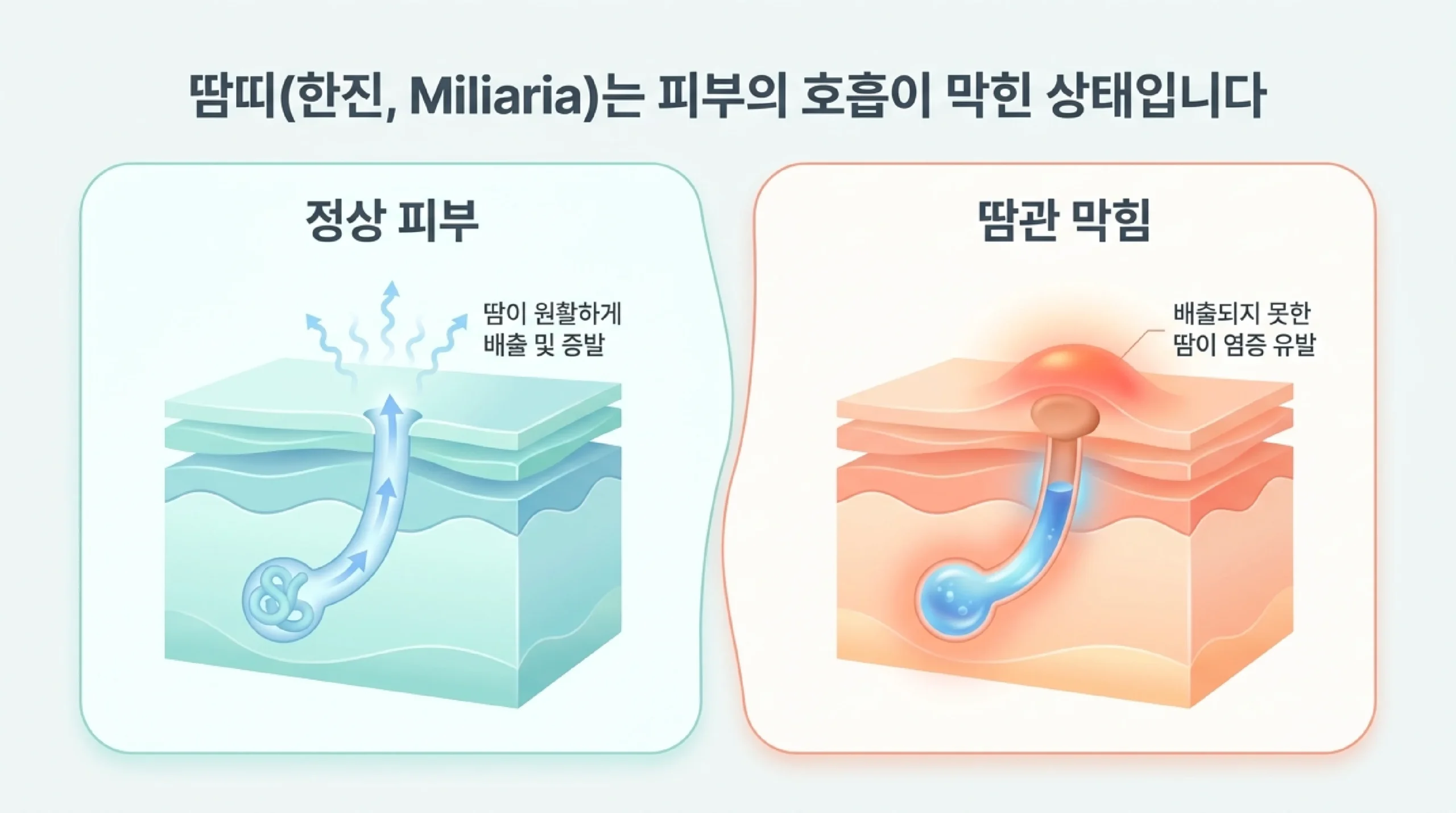 땀띠(한진) 의학적 정의 — 땀관 막힘 원리와 결정·홍색·심재성 3가지 유형