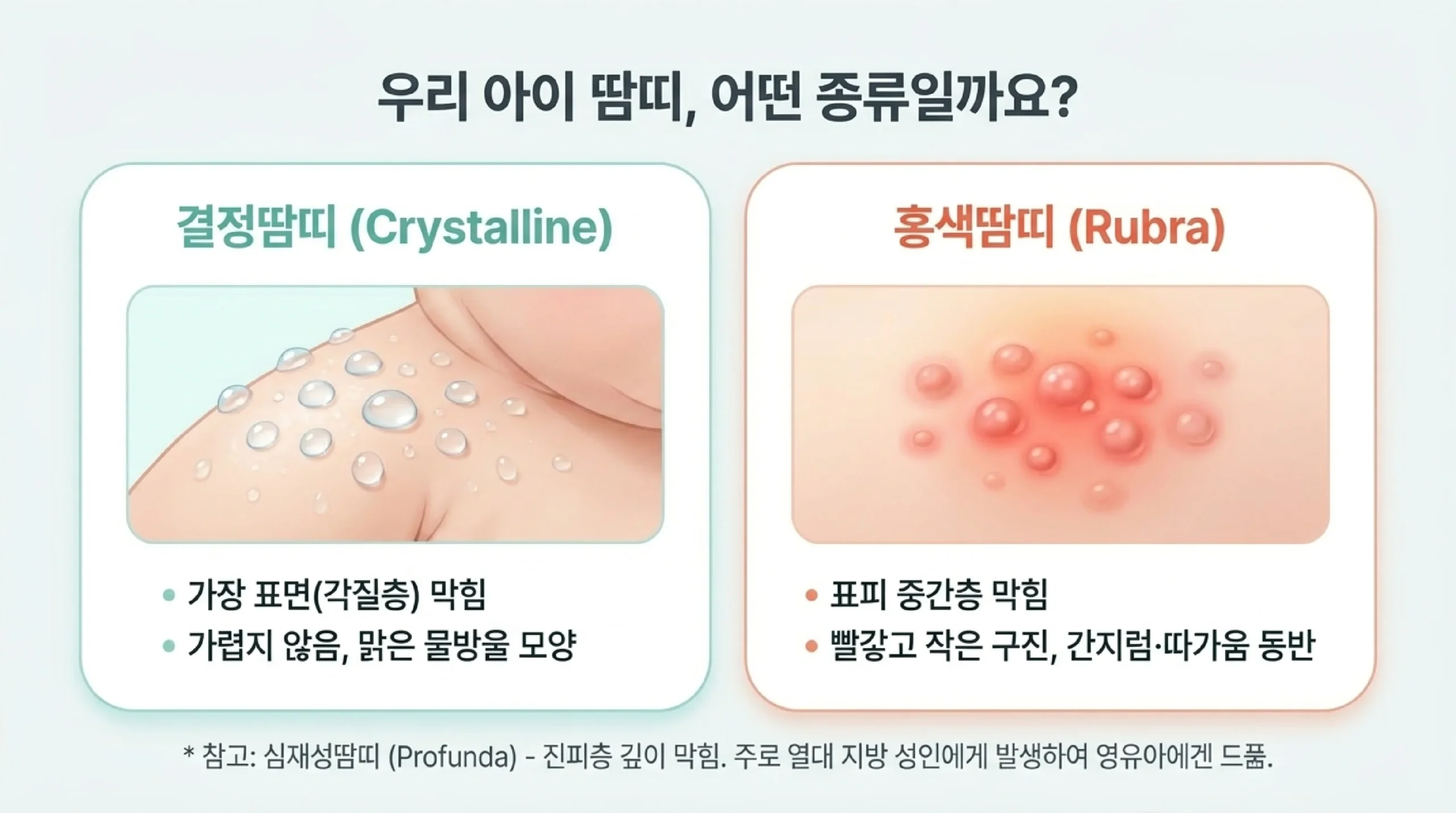 땀띠 종류 비교 — 결정땀띠(Crystalline) vs 홍색땀띠(Rubra) 증상과 외관