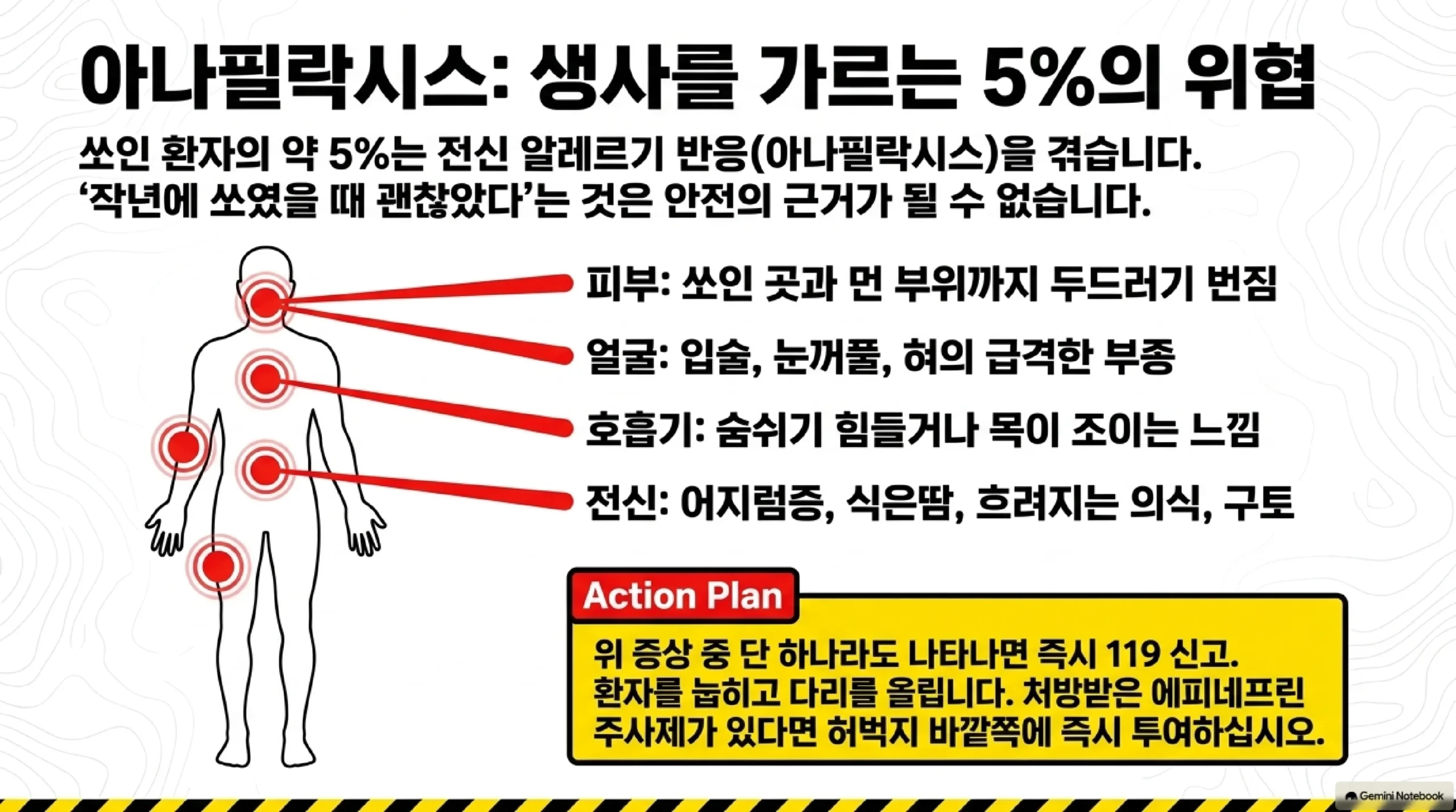 벌에 쏘인 뒤 아나필락시스를 알리는 신호 — 쏘인 환자의 약 5퍼센트가 전신 알레르기 반응을 겪고 작년에 괜찮았다는 것은 안전의 근거가 되지 않으며, 쏘인 곳과 먼 부위까지 두드러기가 번지거나 입술과 눈꺼풀과 혀가 급격히 붓거나 숨쉬기 힘들고 목이 조이거나 어지럼증과 식은땀과 의식 저하가 나타나면 즉시 119에 신고하고 환자를 눕혀 다리를 올리며 처방받은 에피네프린 주사제가 있다면 허벅지 바깥쪽에 투여한다