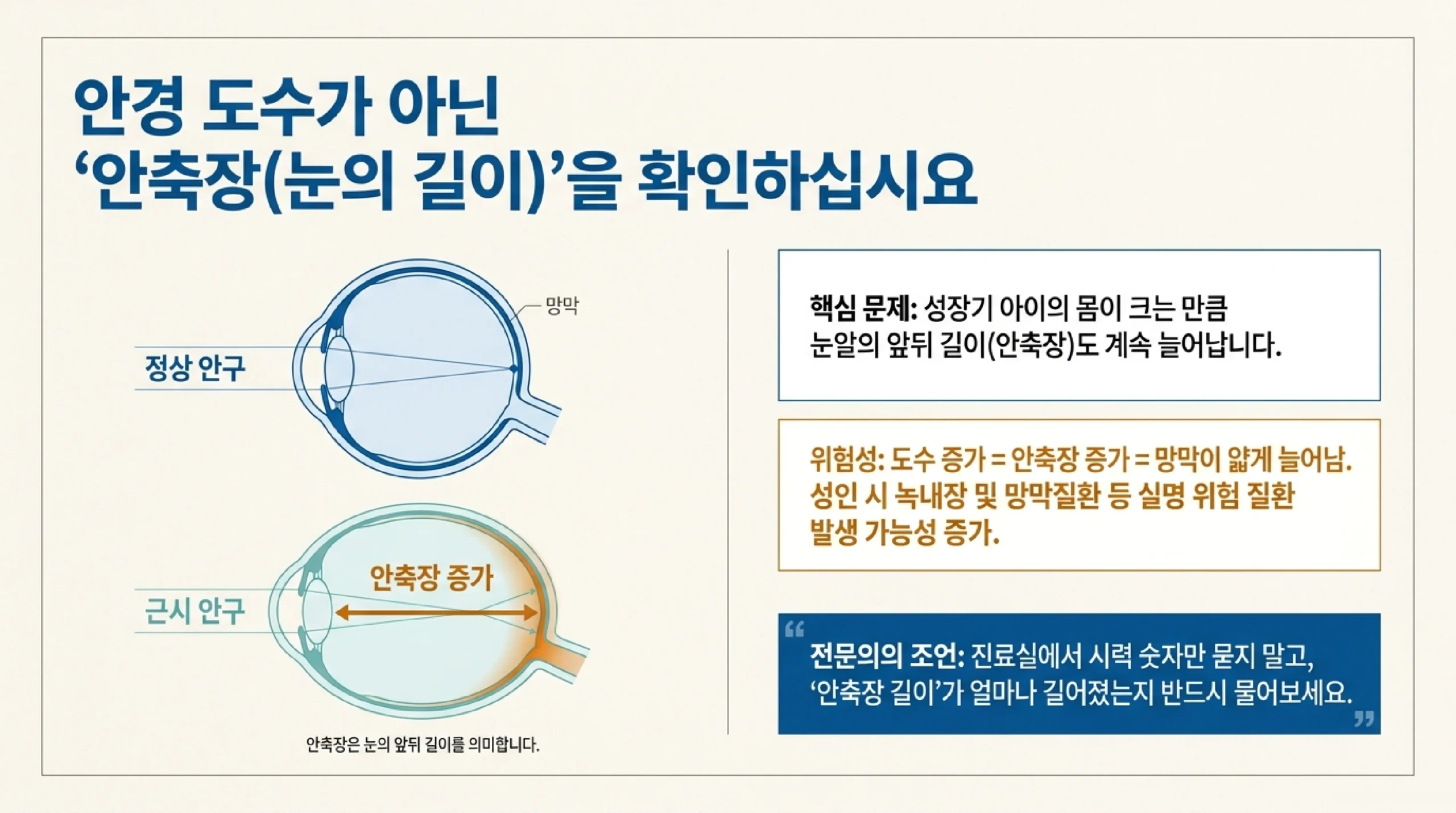 안경 도수가 아닌 안축장을 확인하라는 도식 — 정상 안구와 근시 안구를 나란히 그려 근시 안구는 눈의 앞뒤 길이인 안축장이 늘어나 있고, 성장기 아이는 몸이 크는 만큼 안축장도 늘어나며 도수 증가는 안축장 증가와 망막이 얇게 늘어나는 것과 같아 성인이 된 뒤 녹내장과 망막질환 같은 실명 위험 질환 가능성이 커지므로 진료실에서 시력 숫자만 묻지 말고 안축장 길이가 얼마나 길어졌는지 물어보라는 안내