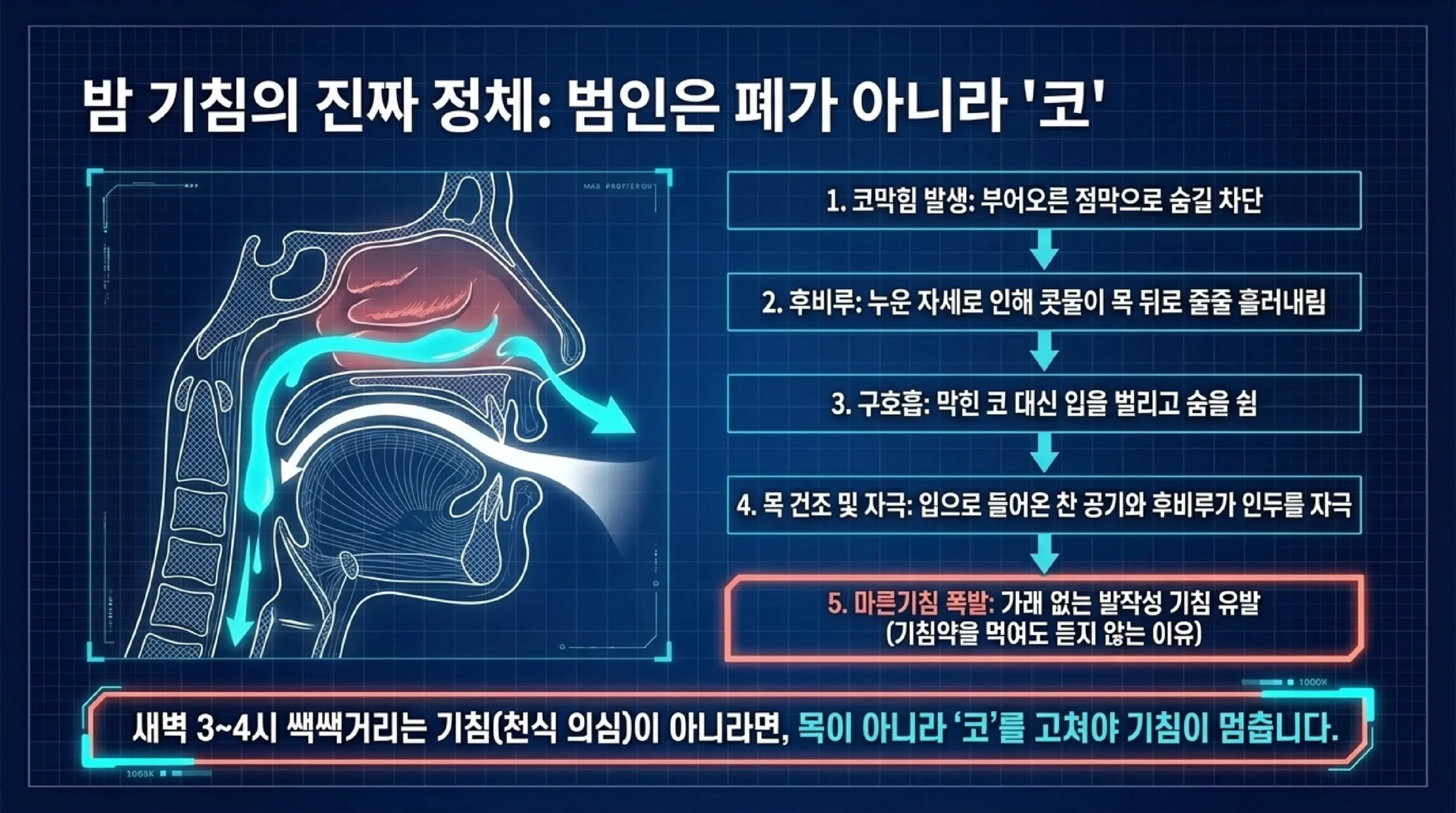 밤에만 나는 기침이 코에서 시작되는 과정을 다섯 단계로 그린 도해 — 코막힘이 생기고, 누운 자세 때문에 콧물이 목 뒤로 흘러내리는 후비루가 생기고, 막힌 코 대신 입으로 숨을 쉬게 되고, 입으로 들어온 찬 공기와 후비루가 인두를 자극해 목이 마르고, 결국 가래 없는 마른기침이 터지므로 목이 아니라 코를 다뤄야 기침이 멎는다는 설명